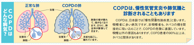 COPDはどんな病気？