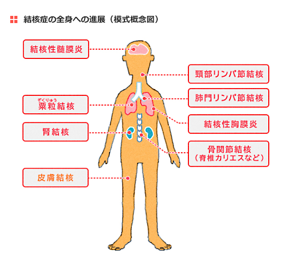 結核 癌 に なり にくい